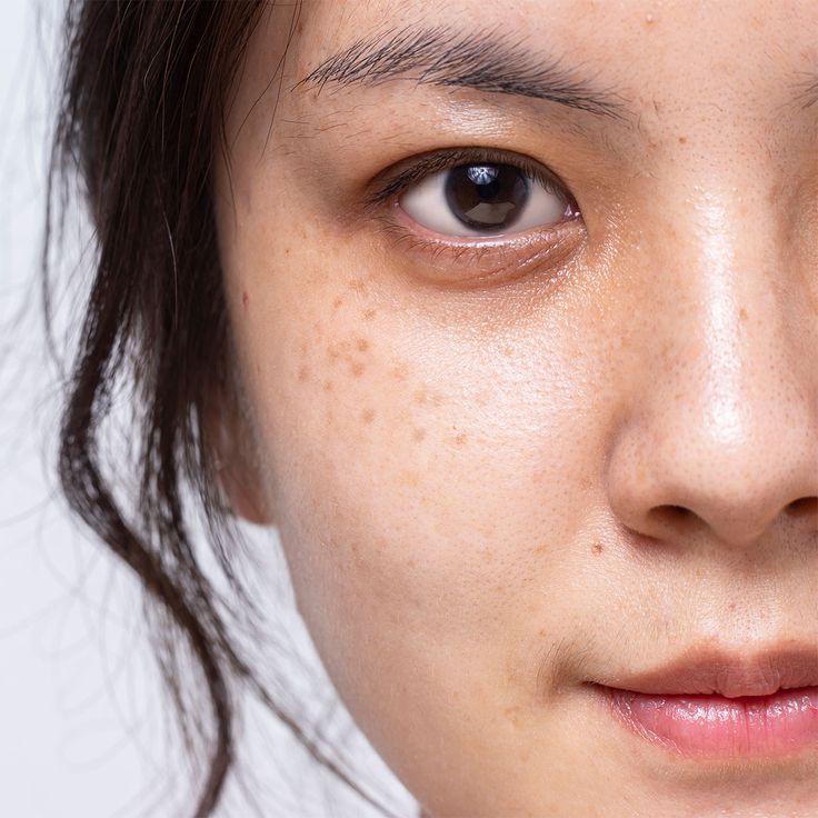 Dark spots